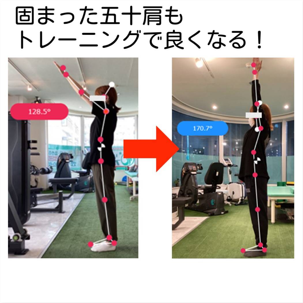 五十肩を克服！50代から始める姿勢改善プログラムの成功事例」｜五十肩