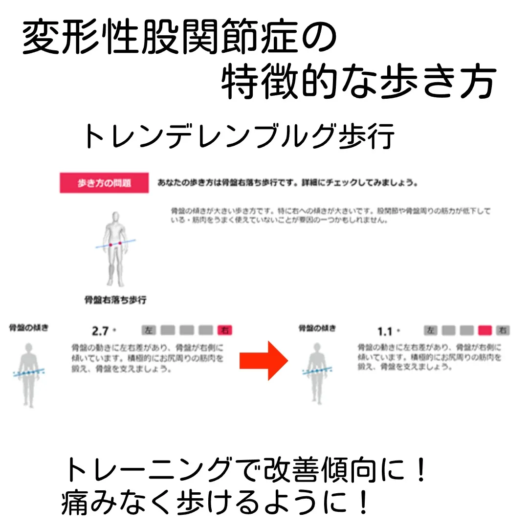 変形性股関節症の改善事例：歩行解析とトレーニング効果